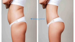 Brazilian Butt Lift in Turkey Advantages