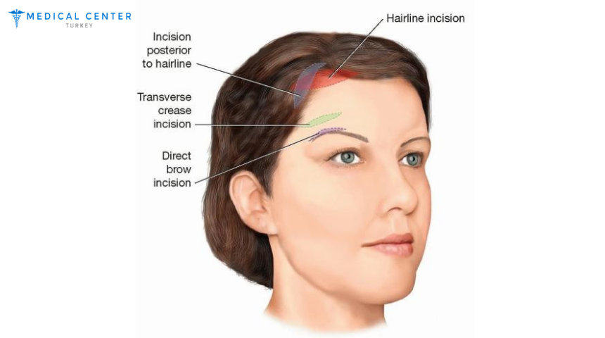 Non-Surgical Brow Lift Techniques in Turkey