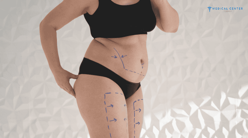 Why Liposuction in Turkey is the Best Option for You? Why Liposuction in Turkey is the Best Option for You?