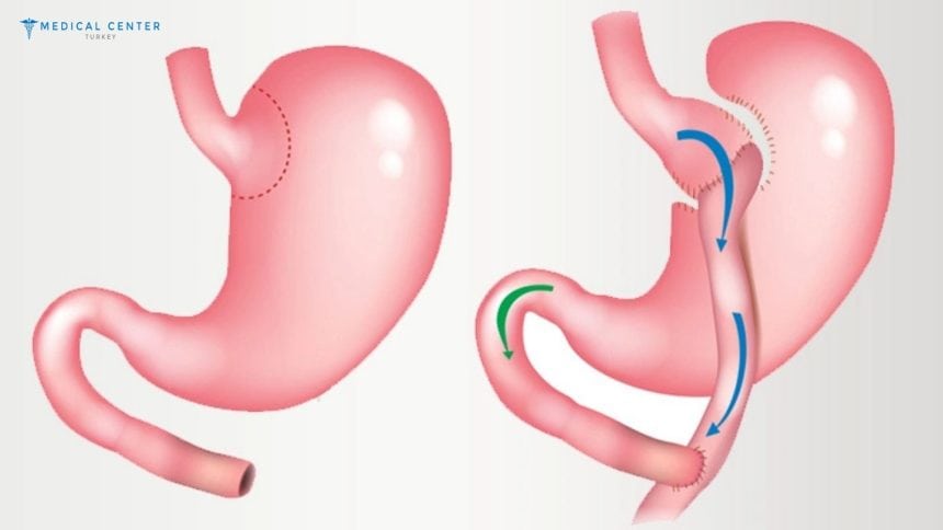 Are you Eligible for Gastric Bypass Surgery in Turkey? Are you Eligible for Gastric Bypass Surgery in Turkey?