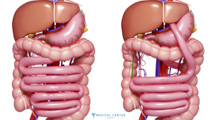 Advantages of a Gastric Bypass in Turkey 2025 