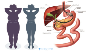 Advantages of a Gastric Bypass in Turkey 2025