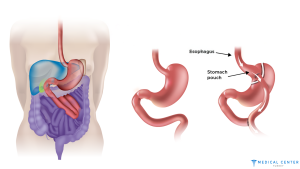 Advantages of a Gastric Bypass in Turkey 2025