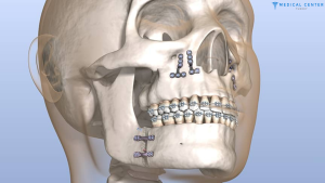 Are You Suitable for Jaw Surgery in Turkey?