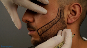 Beard Transplant in Turkey: Lower Cost, Top Care