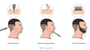 Beard Transplant in Turkey: Lower Cost, Top Care