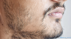 Beard Transplant in Turkey: Lower Cost, Top Care