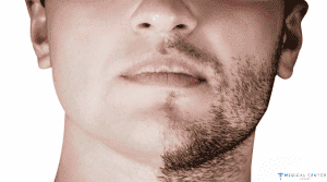 Beard Transplant in Turkey: Lower Cost, Top Care