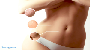 Laser Lipo vs. Vaser Lipo: Which is Better for 2025?