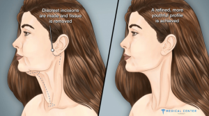 What to Expect After the Neck Lift Surgery in Turkey?