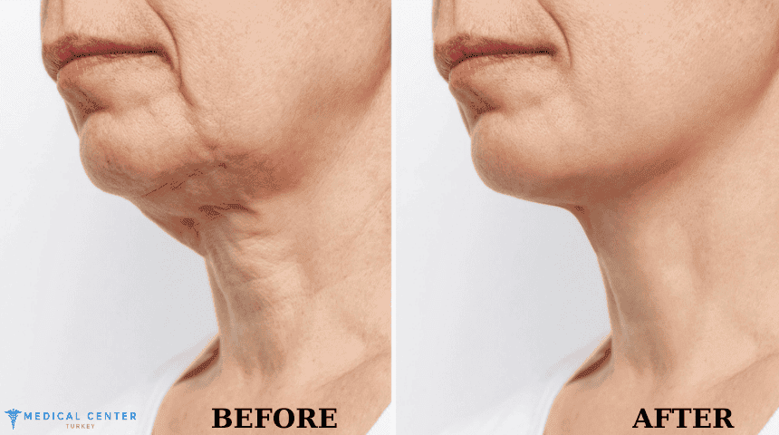 What to Expect After the Neck Lift Surgery in Turkey?