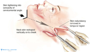 What to Expect After the Neck Lift Surgery in Turkey?