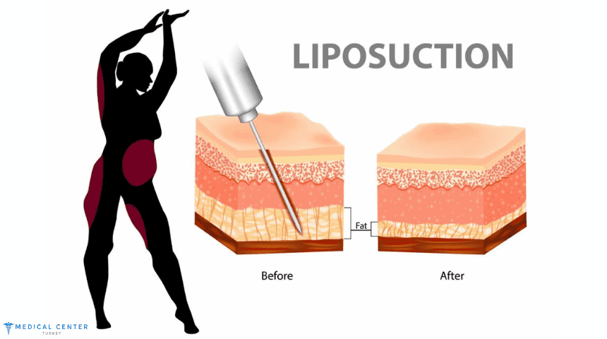 Why Liposuction in Turkey is the Best Option for You?