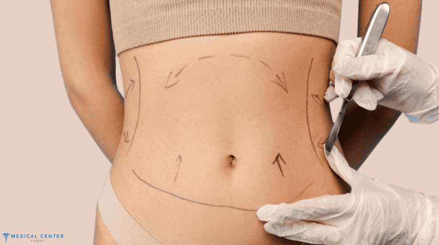 Why Liposuction in Turkey is the Best Option for You?