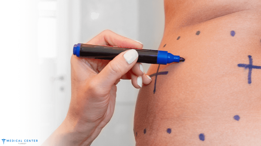 Why Liposuction in Turkey is the Best Option for You?
