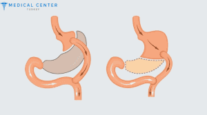 What is the Price of a Gastric Bypass in Turkey 2025?