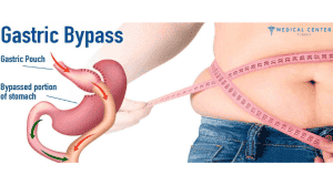 What is the Price of a Gastric Bypass in Turkey 2025?