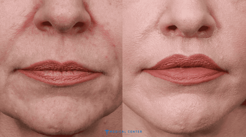 Achieving Fuller Lips with Natural Lip Fillers in Turkey