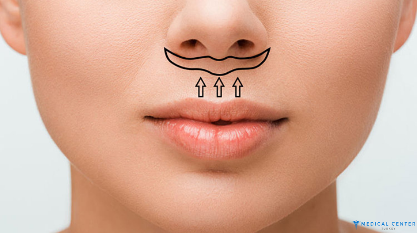 Achieving Fuller Lips with Natural Lip Fillers in Turkey