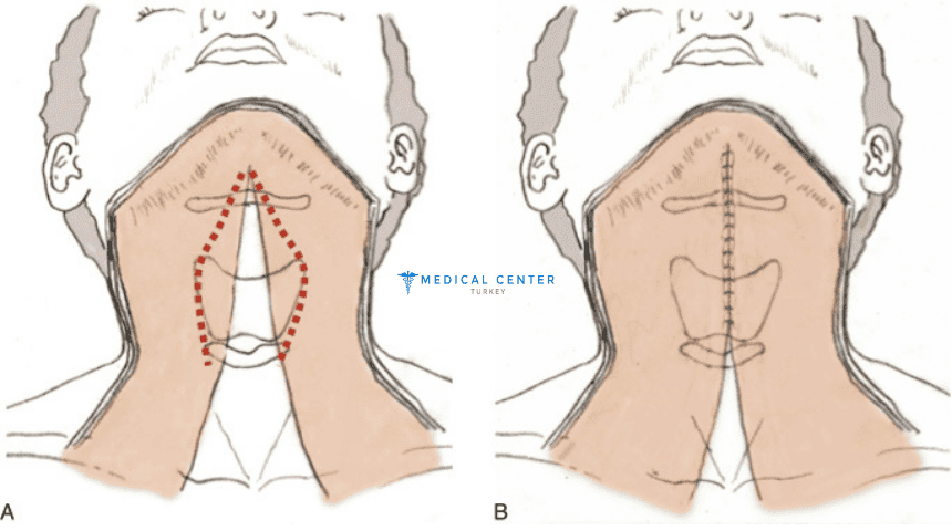 Neck Lift (Platysmaplasty) in Turkey 2025