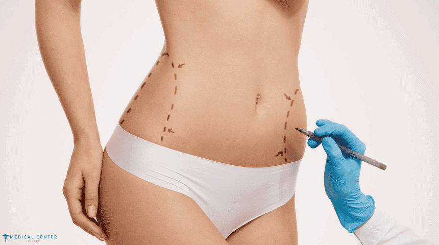 What Are the Risks Involved in Liposuction?