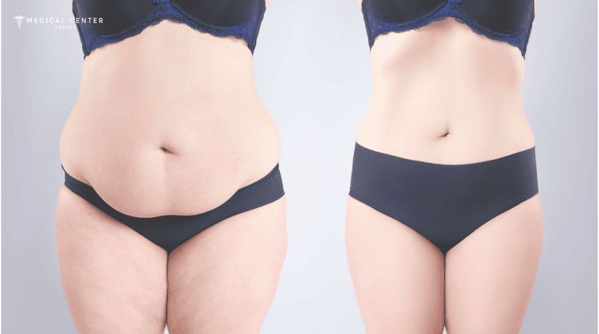 Choosing Between a Tummy Tuck and a Mini Tuck