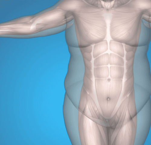 Why is Everyone Talking About Liposuction in Turkey? Why is Everyone Talking About Liposuction in Turkey?