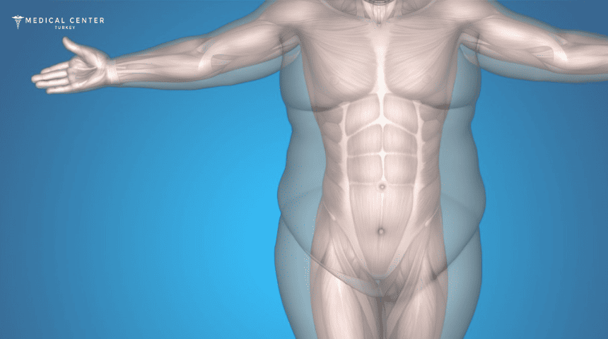 Why is Everyone Talking About Liposuction in Turkey? Why is Everyone Talking About Liposuction in Turkey?