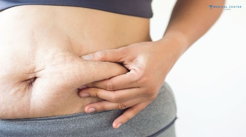 Gastric Bypass vs Gastric Sleeve: What’s Best?