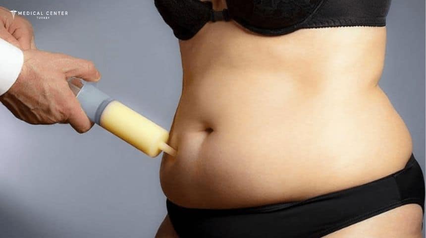 Liposuction in 2025 Liposuction in 2025