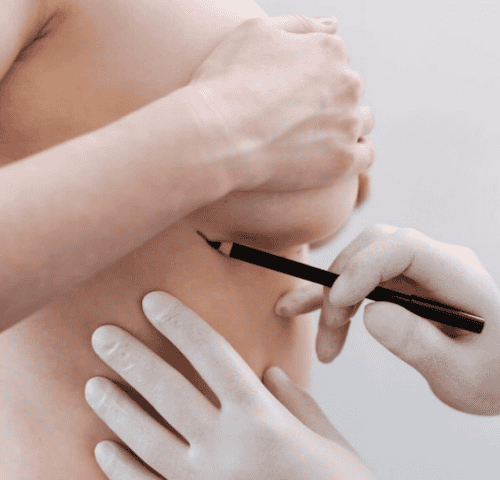 How Much Does a Complete Breast Augmentation Package Cost in 2025?