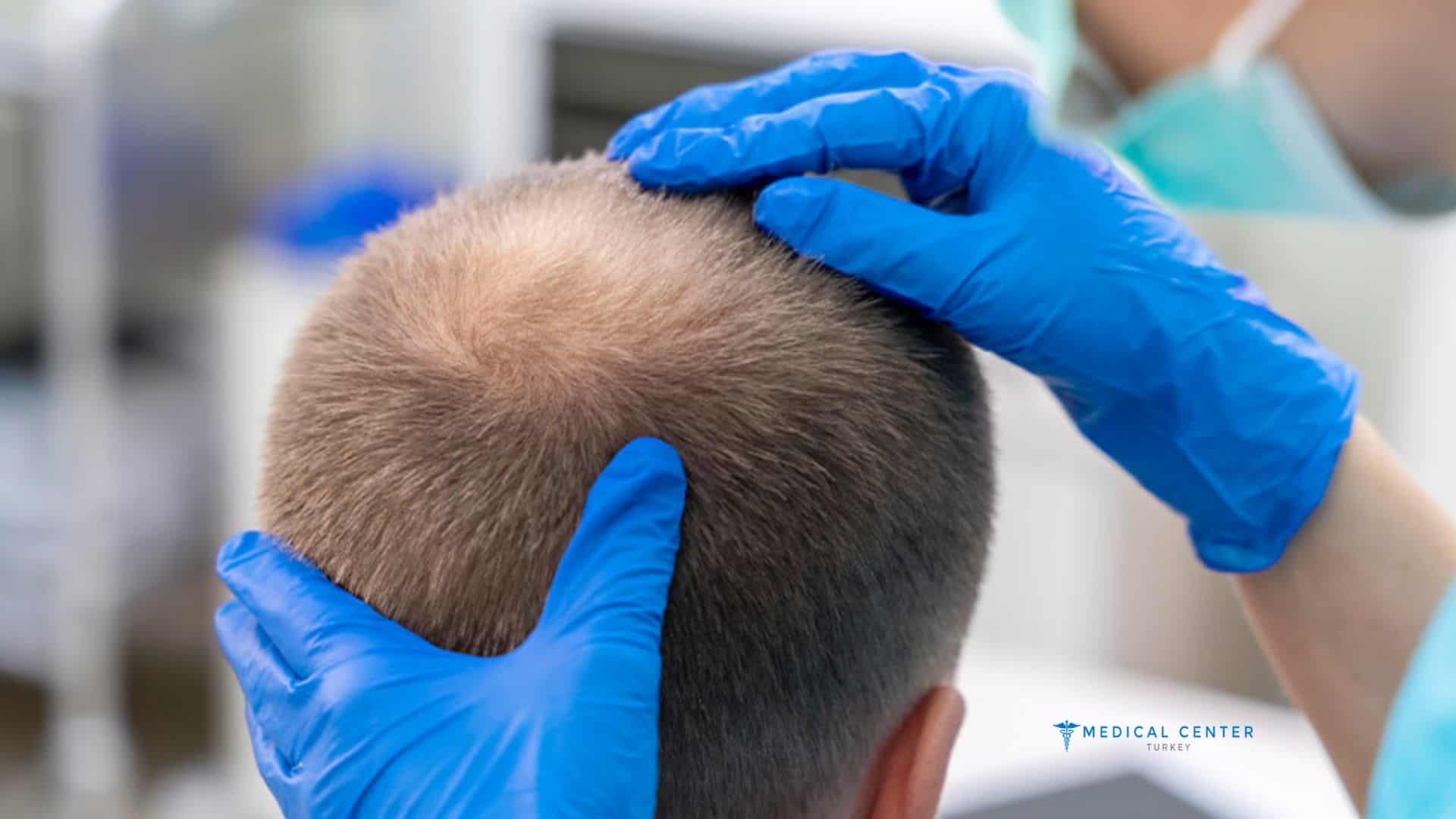 Is DHI Hair Transplant the Best Option for You in 2025