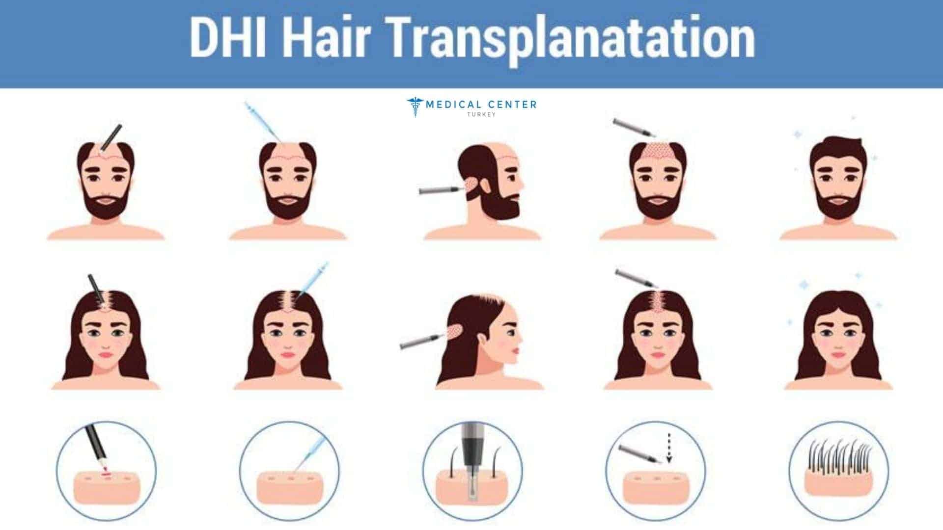Is DHI Hair Transplant the Best Option for You in 2025