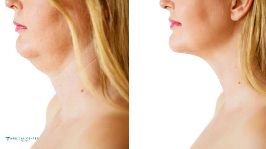 Jowl Liposuction in Turkey Jowl Liposuction in Turkey