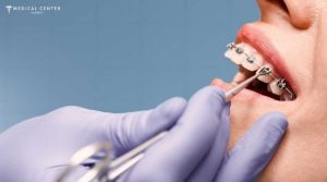 Is Dental Treatment in Turkey Reliable in 2025?