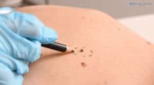 Is Mole Removal in Turkey Safe and Affordable?