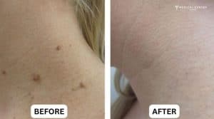 Is Mole Removal in Turkey Safe and Affordable?