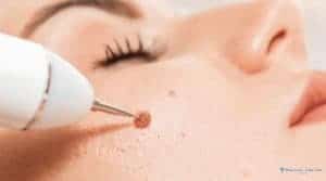 Is Mole Removal in Turkey Safe and Affordable?
