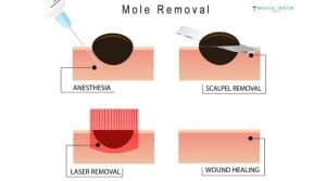 Is Mole Removal in Turkey Safe and Affordable?