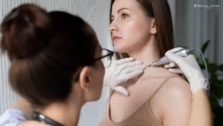 Is Mole Removal in Turkey Safe and Affordable? Is Mole Removal in Turkey Safe and Affordable?