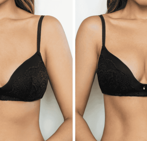 Why Choose Turkey for Breast Augmentation?