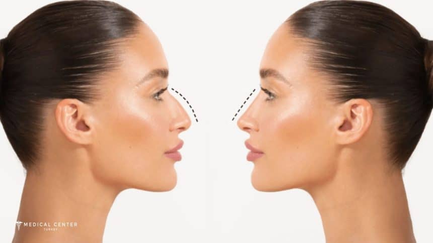 Why Choose Turkey For a Nose Job? Why Choose Turkey For a Nose Job?