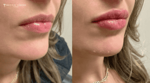Do Lip Fillers Still Look Natural in 2026?