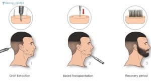 Beard Transplants Are Booming in Turkey