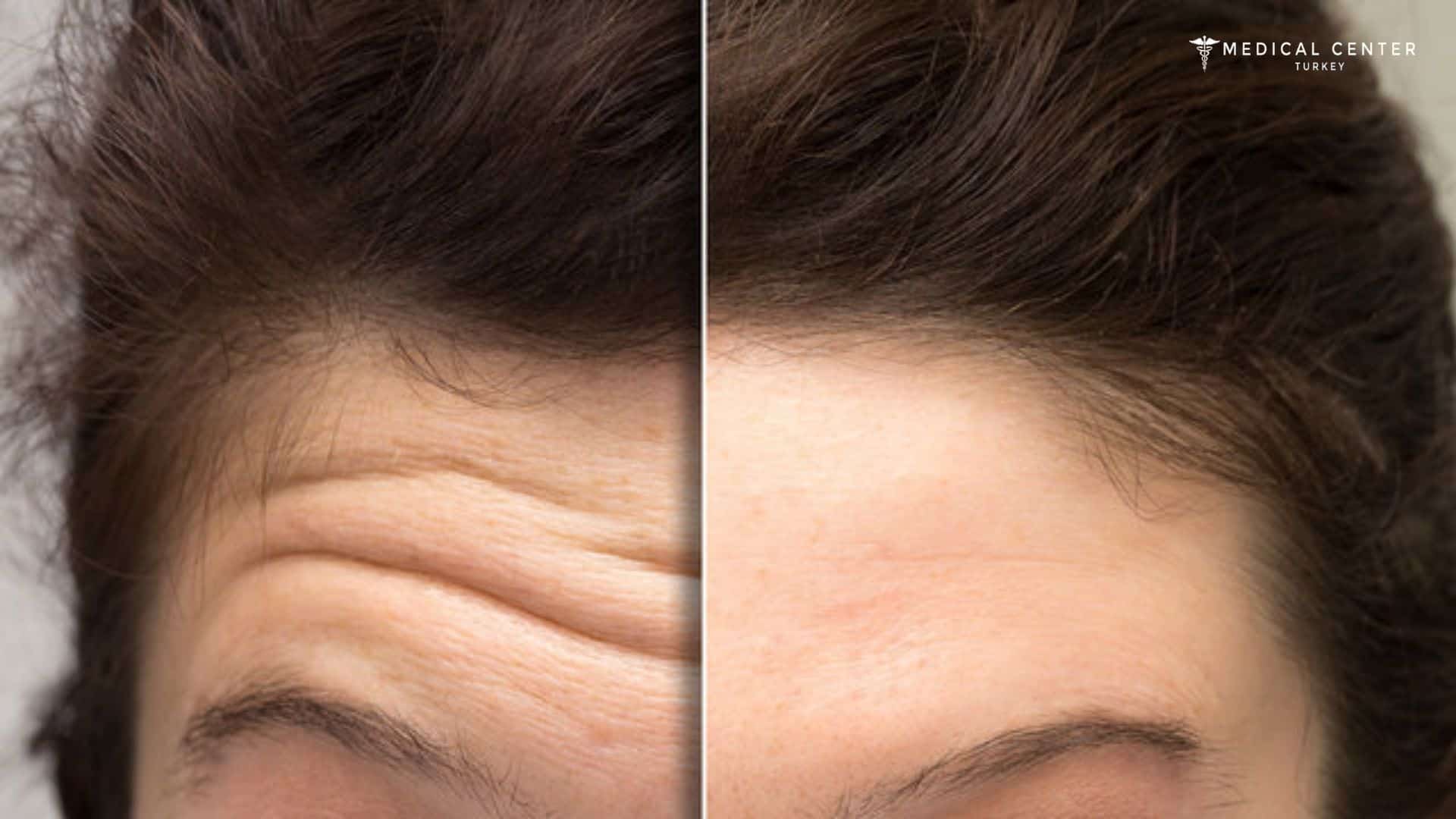Best Botox Alternatives Right Now in Turkey