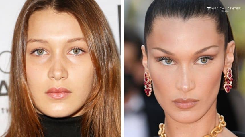 Bella Eyes Surgery in Turkey