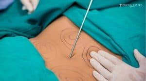 What is New in HD Liposuction for 2026?