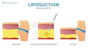 What is New in HD Liposuction for 2026?