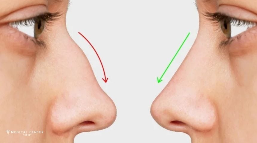 Which Is Better Open or Closed Rhinoplasty?
