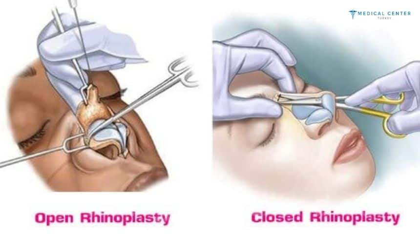 Which Is Better Open or Closed Rhinoplasty?